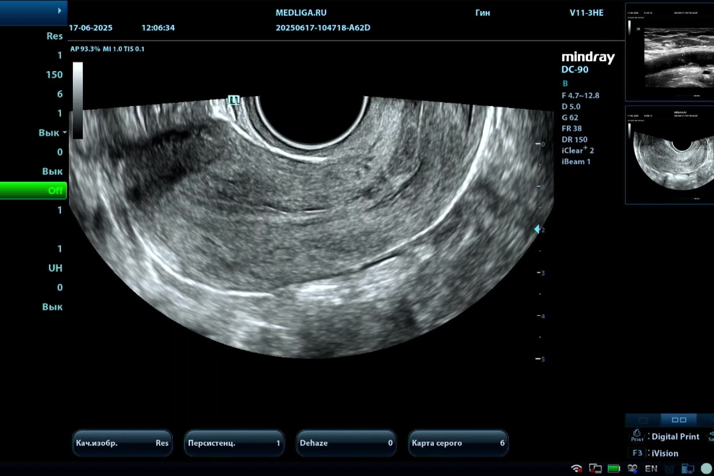 Mindray DC-90: стандартное гинекологическое исследование